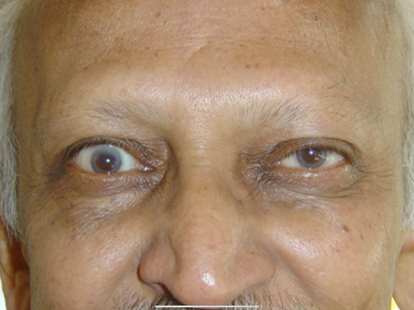 He underwent right orbital decompression, achieving a good, symmetrical globe position, with persistent right upper eyelid retraction