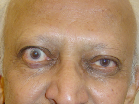Following treatment with steroids and radiotherapy.
His left normalised and he had residual prominence of the right eye
